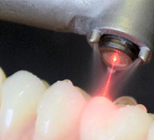laser dentistry, laser teeth whitening