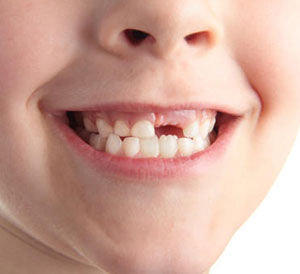 Replace Missing Tooth