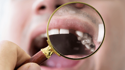 Missing Teeth dental treatment in Hyderabad