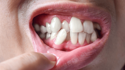 Crooked Teeth Treatment in Hyderabad