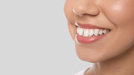 Teeth Gap Filling Treatment in Hyderabad by aligners and braces