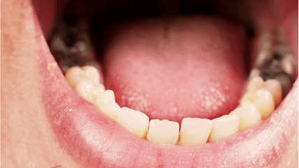 Tooth decay dental care treatment in Hyderabad at Dr. Gowd’s Dental