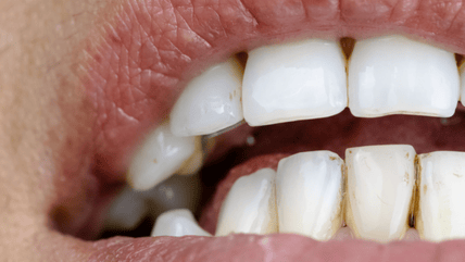 Teeth stain removal treatment in Hyderabad at Dr. Gowd’s Dental