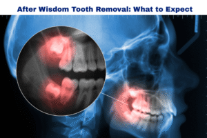 after wisdom tooth removal surgery tips
