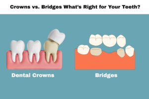 crowns vs. bridges