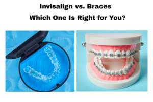 Invisalign vs braces