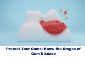 stages of gum disease