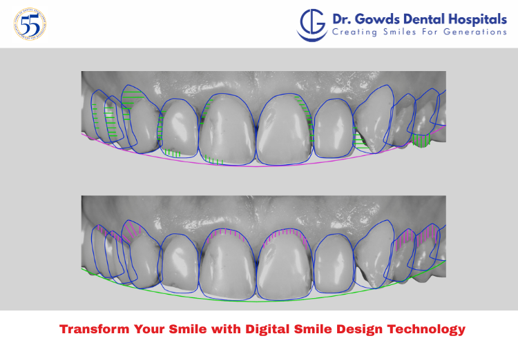 digital smile design preview