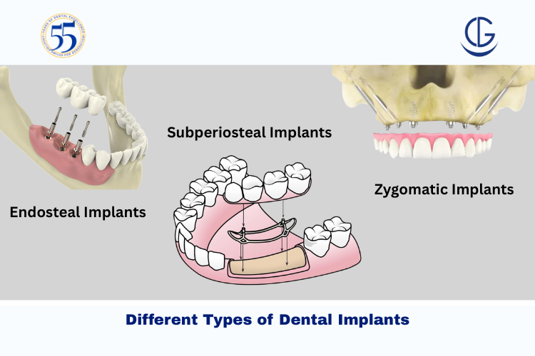 types of dental implants