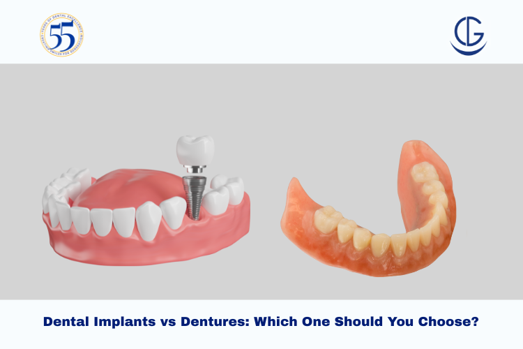Dental Implants vs Dentures