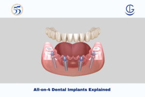 All on 4 dental implants