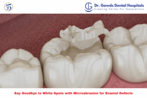 Dental microabrasion for enamel defects