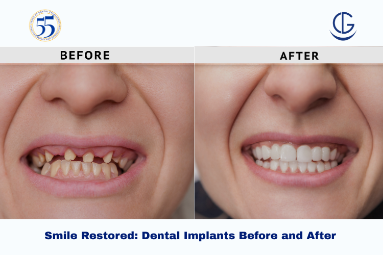 dental implants before and after