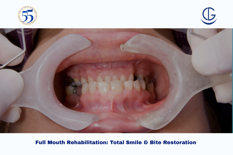 Full Mouth Rehabilitation in Hyderabad