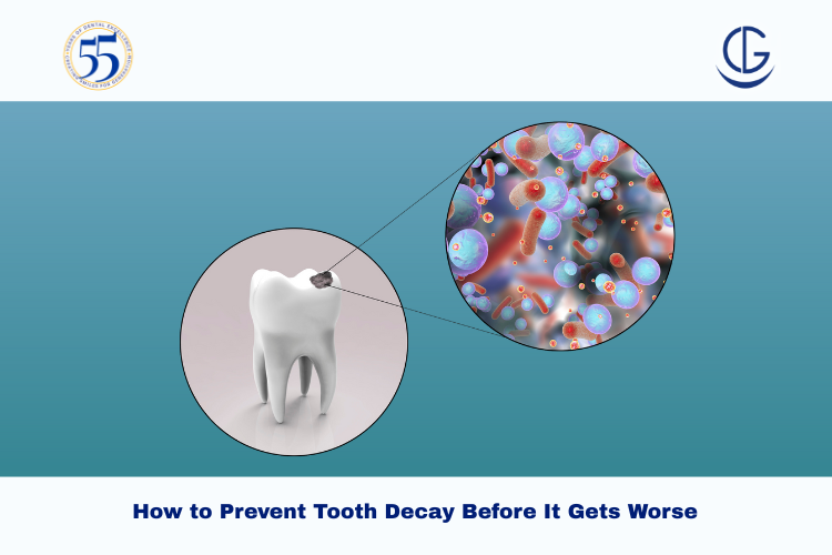 Tooth Decay