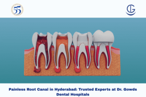 painless root canal