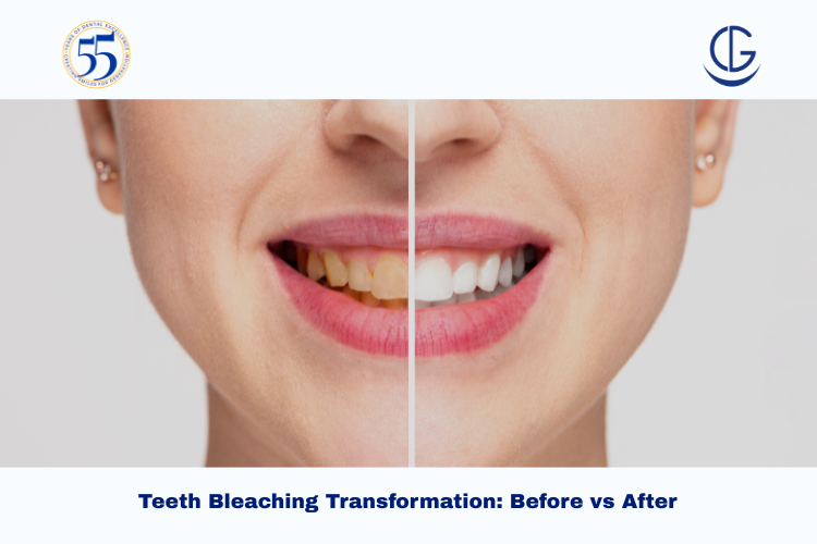 Teeth Bleaching Before and After