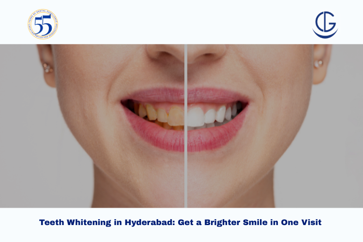 teeth whitening