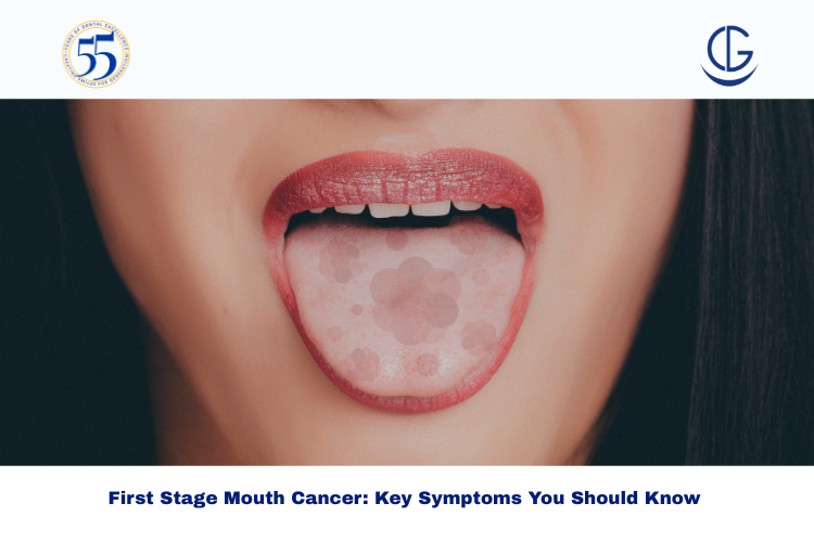 first stage mouth cancer