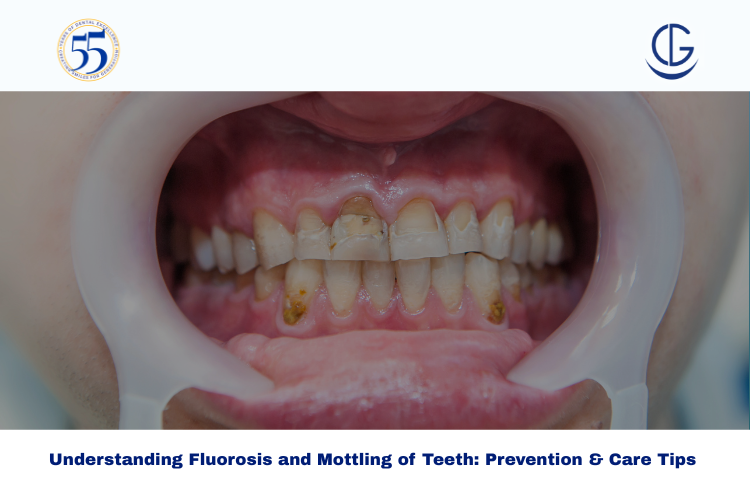 mottling of teeth