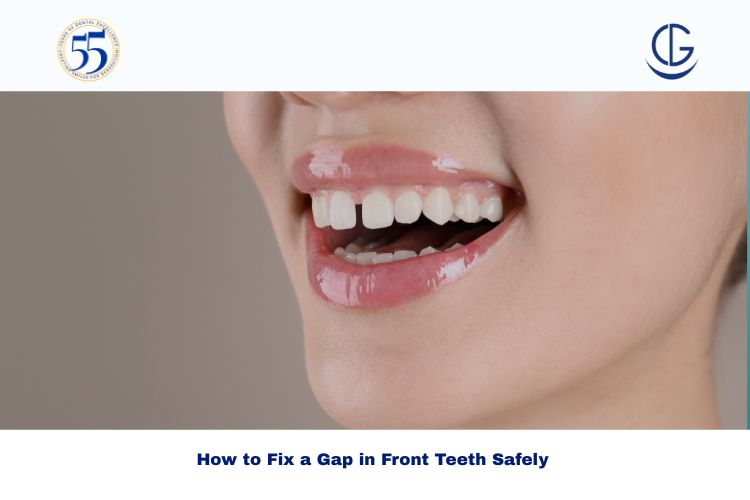 gap in front teeth