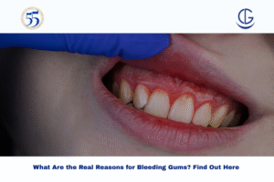 reasons for bleeding gums