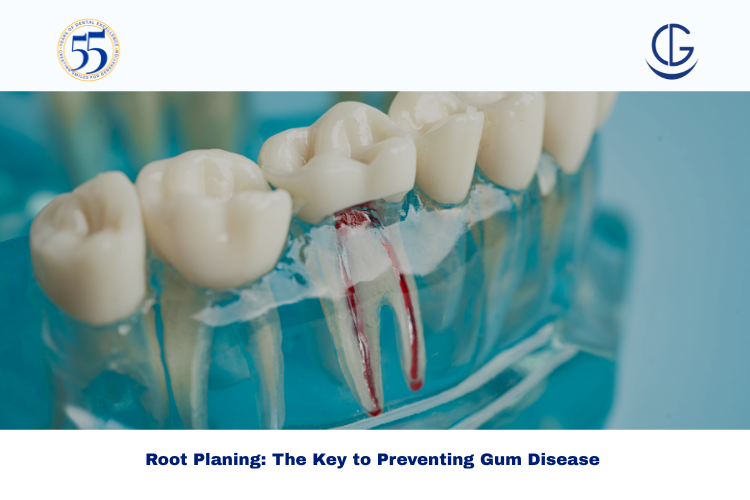 root planing