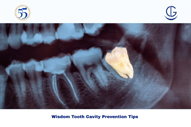 wisdom tooth cavity
