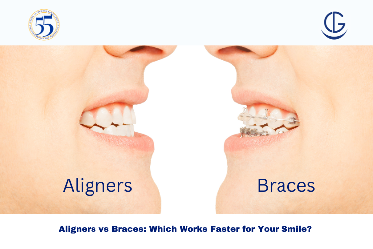 aligners vs braces