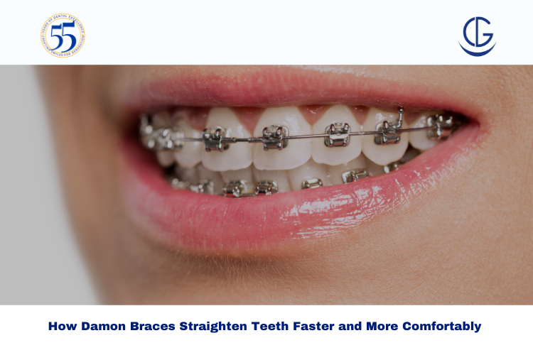 Damon Braces