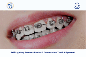 Self Ligating Braces