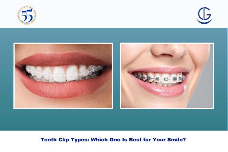 teeth clip types