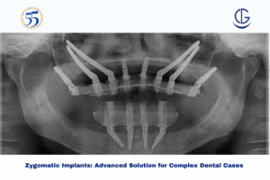 Zygomatic Implants