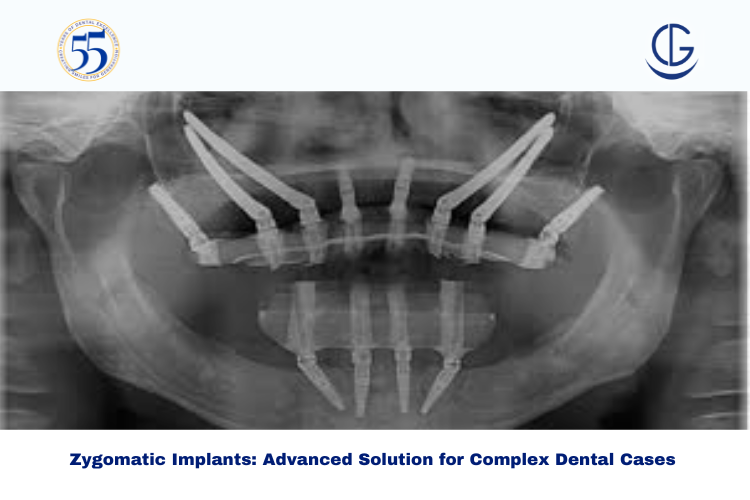 Zygomatic Implants