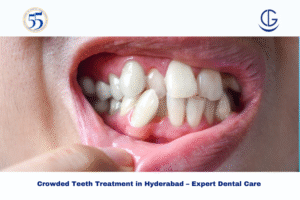 crowded teeth