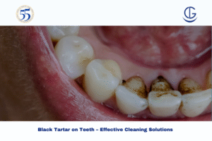 black tartar on teeth