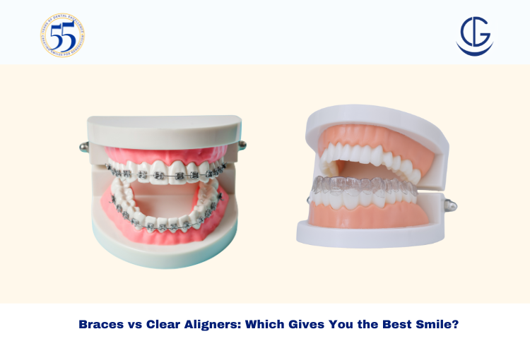 braces vs clear aligners