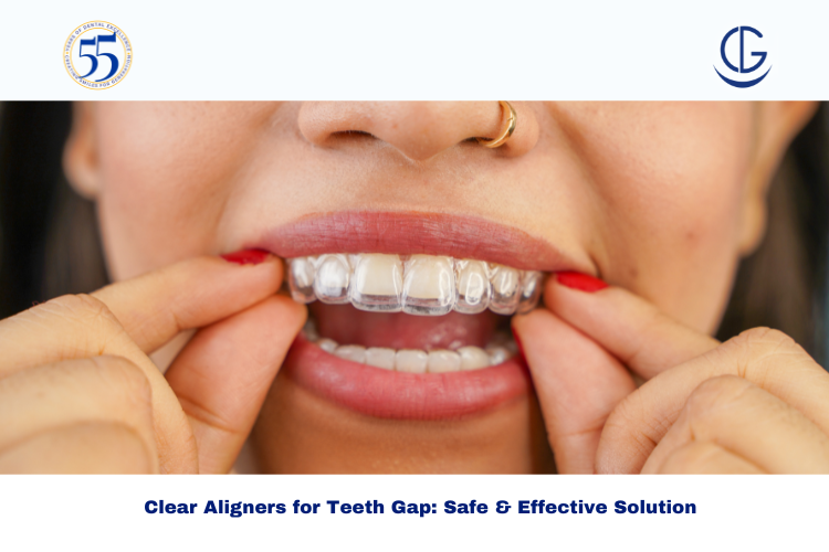 Clear Aligners for Teeth Gap