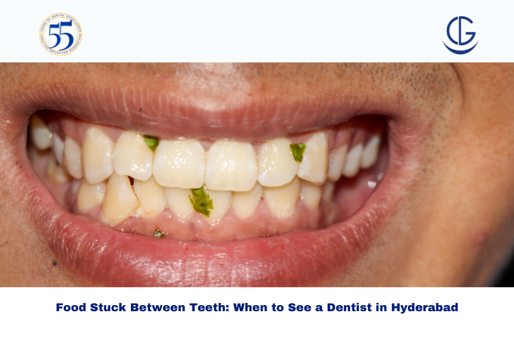 Food Stuck Between Teeth