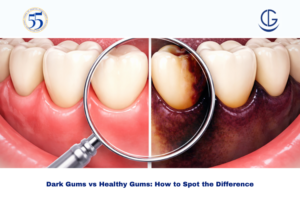 Dark Gums vs Healthy Gums