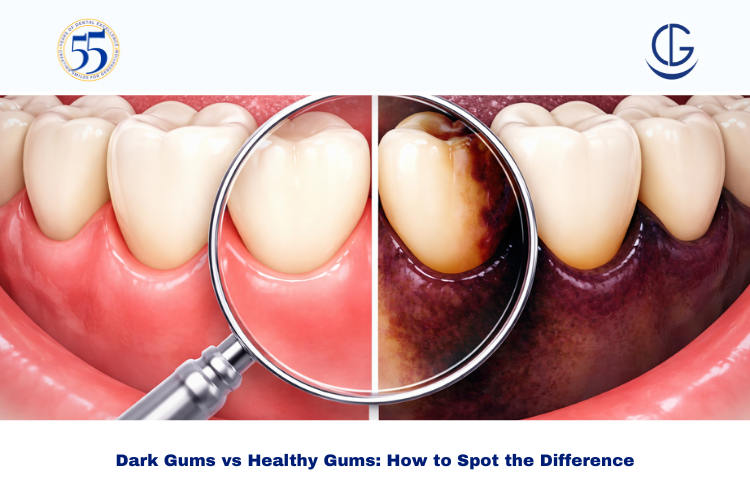 Dark Gums vs Healthy Gums