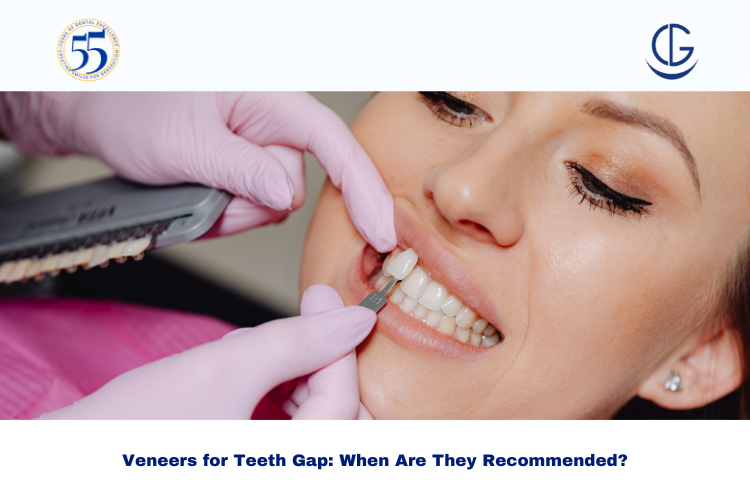 Veneers for Teeth Gap