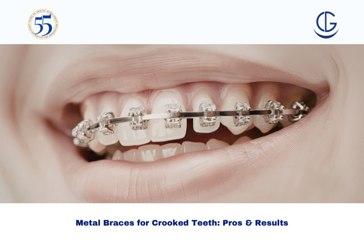 metal braces for crooked teeth