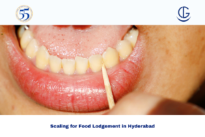 scaling for food lodgement