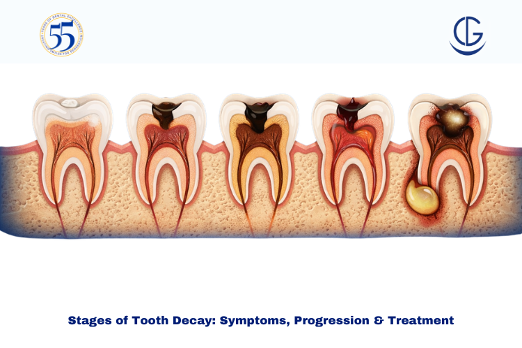 stages of tooth decay
