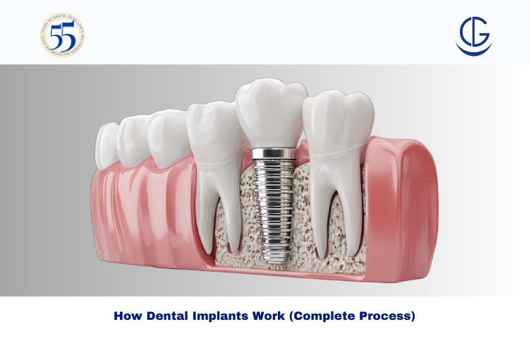 Dental Implant procedure