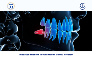 Impacted wisdom teeth