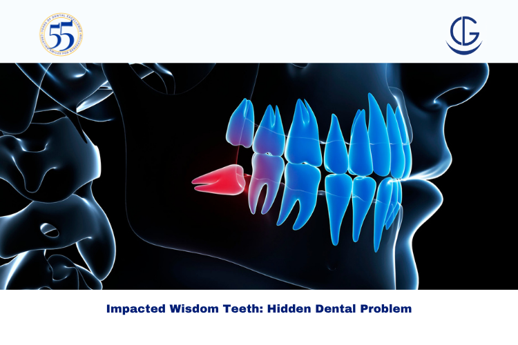 Impacted wisdom teeth