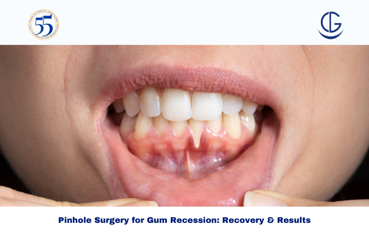 Pinhole Surgery for Gum Recession