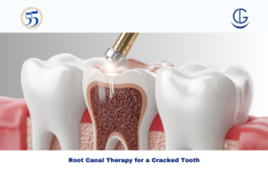 Root Canal Therapy